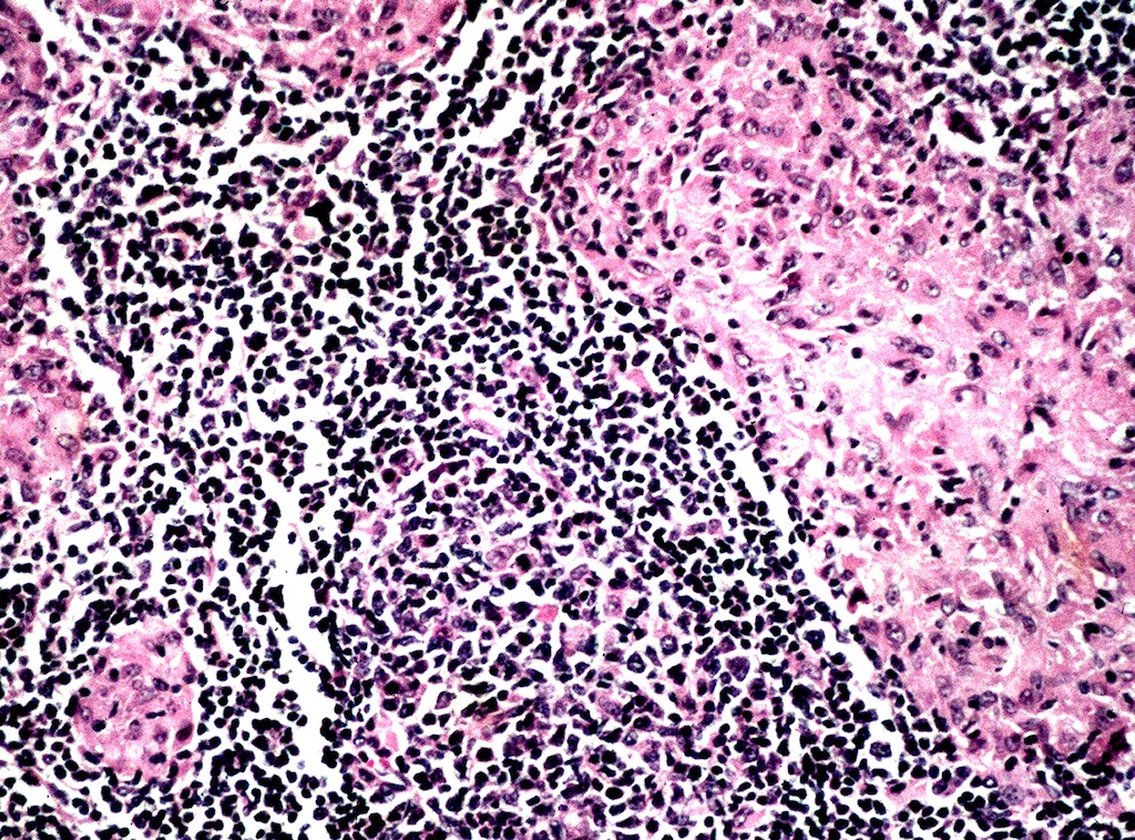 Pathology Outlines - Tuberculosis